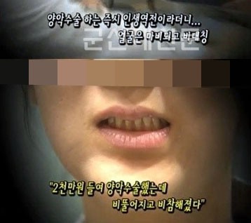 양악수술의 위험성