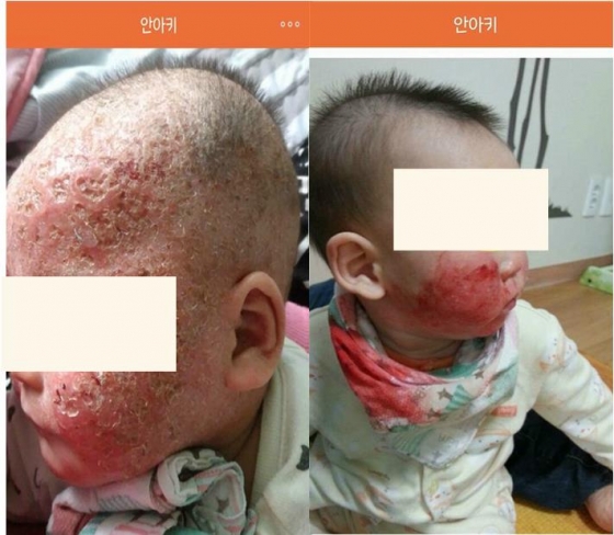 간장으로 코세척, 숯가루 먹이기, ‘안아키’…자연치유 육아 논란
